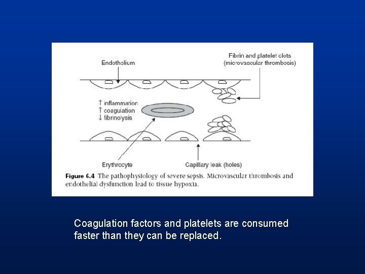 Coagulation factors and platelets are consumed faster than they can be replaced. 