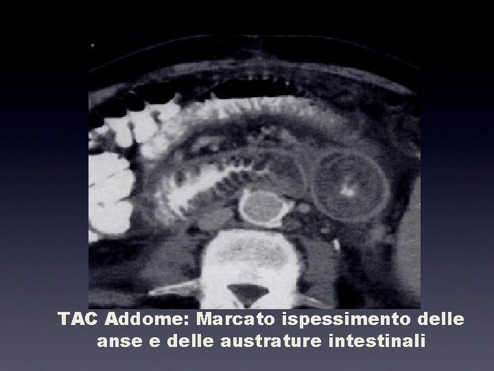 TAC Addome: Marcato ispessimento delle anse e delle austrature intestinali 