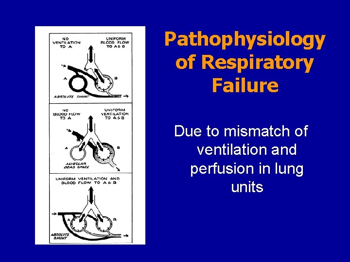 Pathophysiology of Respiratory Failure Due to mismatch of ventilation and perfusion in lung units