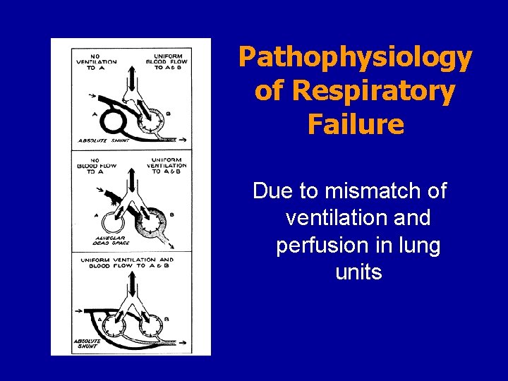Pathophysiology of Respiratory Failure Due to mismatch of ventilation and perfusion in lung units