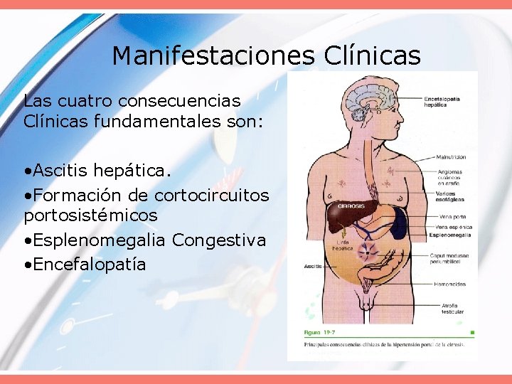 Manifestaciones Clínicas Las cuatro consecuencias Clínicas fundamentales son: • Ascitis hepática. • Formación de