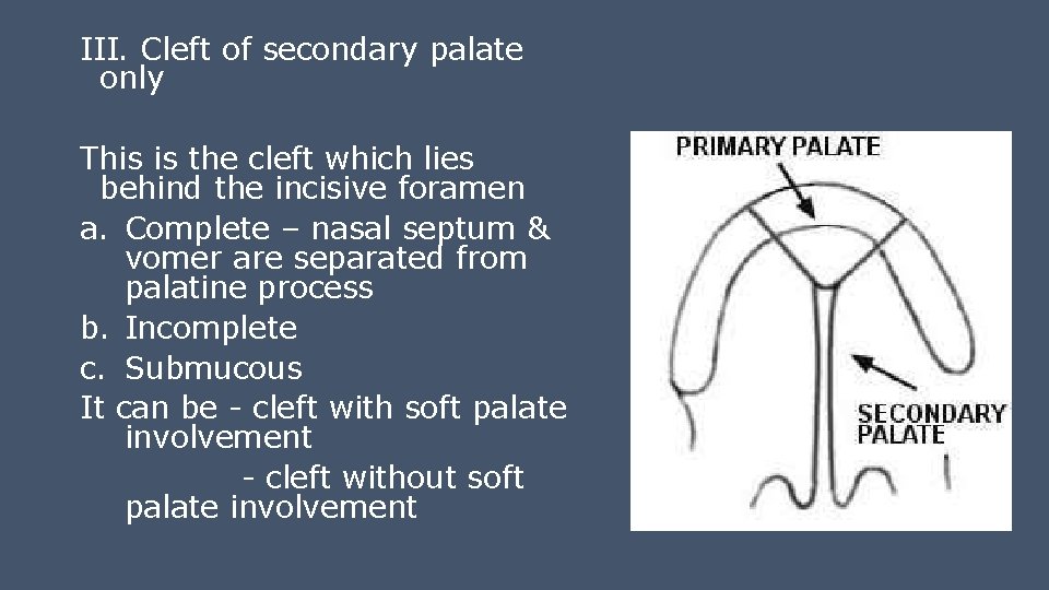 III. Cleft of secondary palate only This is the cleft which lies behind the