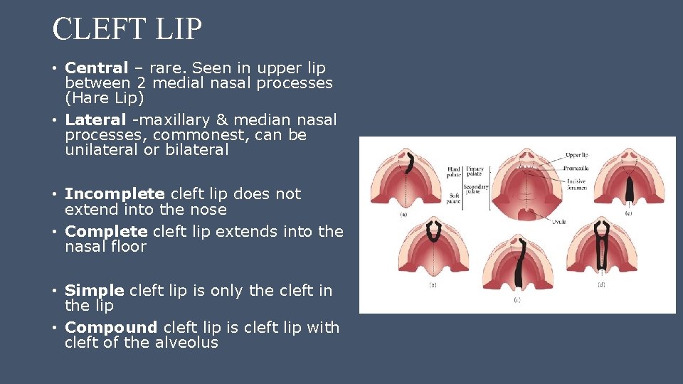 CLEFT LIP • Central – rare. Seen in upper lip between 2 medial nasal