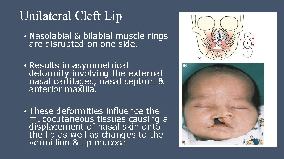 Unilateral Cleft Lip • Nasolabial & bilabial muscle rings are disrupted on one side.