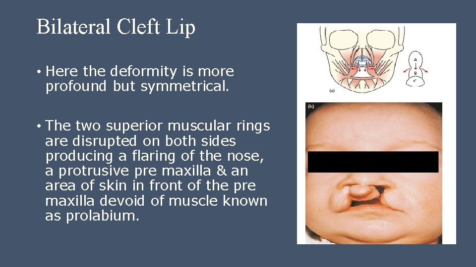 Bilateral Cleft Lip • Here the deformity is more profound but symmetrical. • The Bilateral Cleft Lip • Here the deformity is more profound but symmetrical. • The