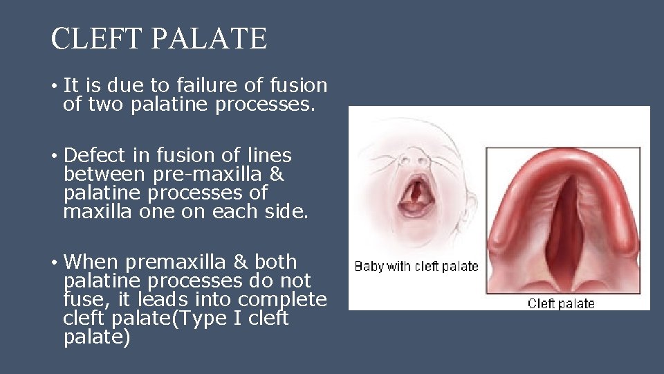 CLEFT PALATE • It is due to failure of fusion of two palatine processes.