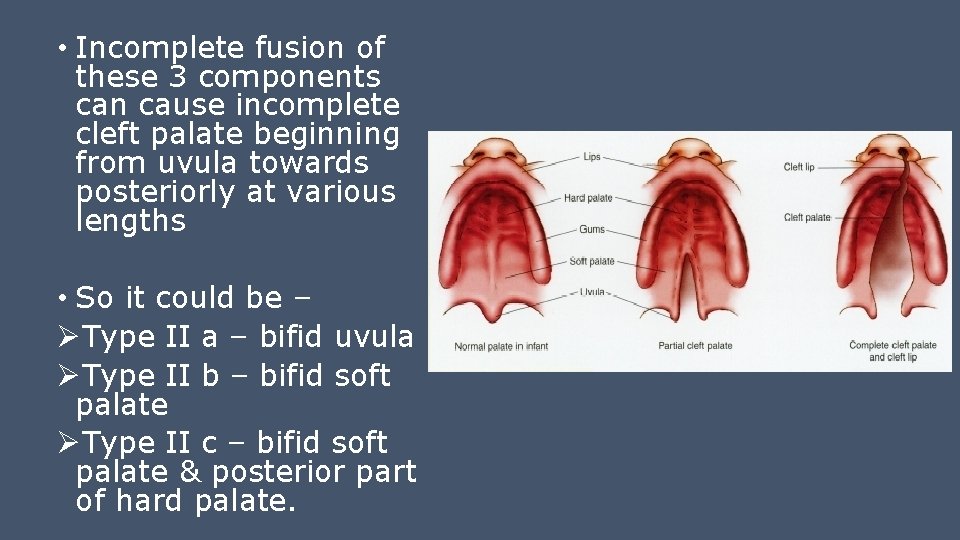  • Incomplete fusion of these 3 components can cause incomplete cleft palate beginning