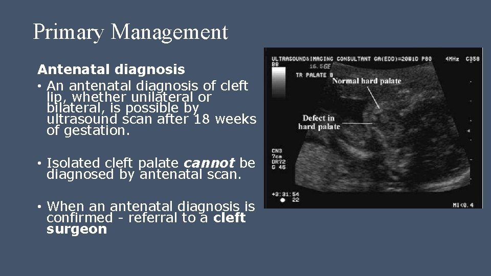 Primary Management Antenatal diagnosis • An antenatal diagnosis of cleft lip, whether unilateral or