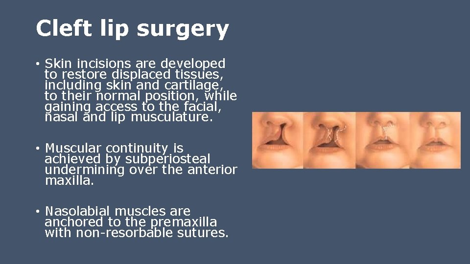 Cleft lip surgery • Skin incisions are developed to restore displaced tissues, including skin