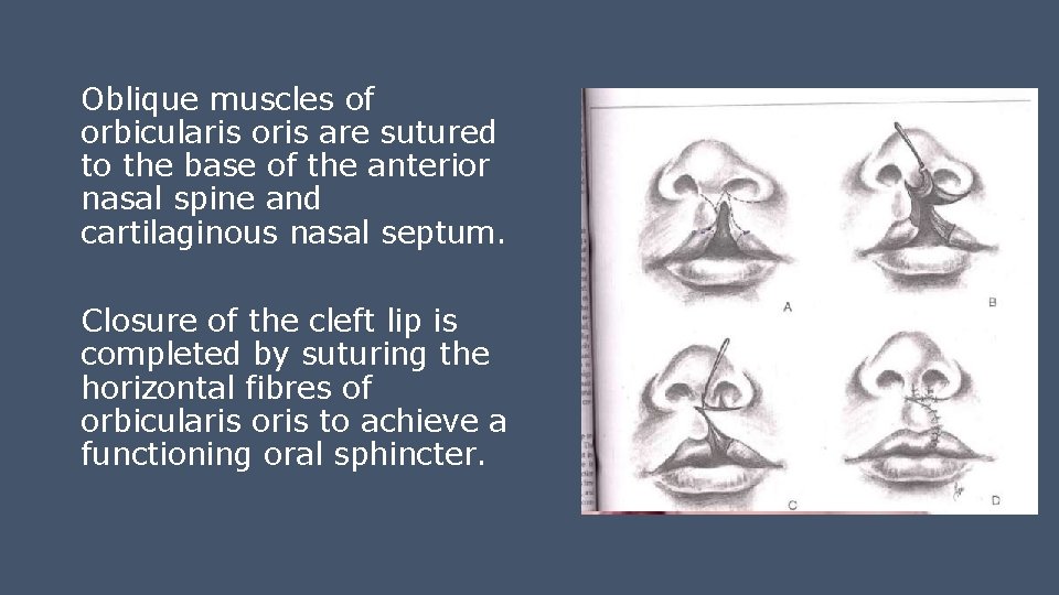 Oblique muscles of orbicularis oris are sutured to the base of the anterior nasal