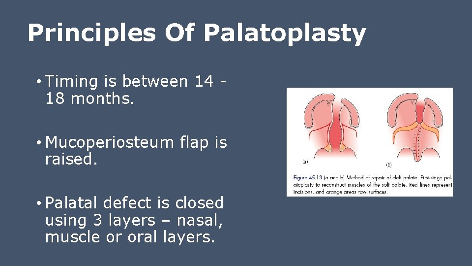 Principles Of Palatoplasty • Timing is between 14 18 months. • Mucoperiosteum flap is
