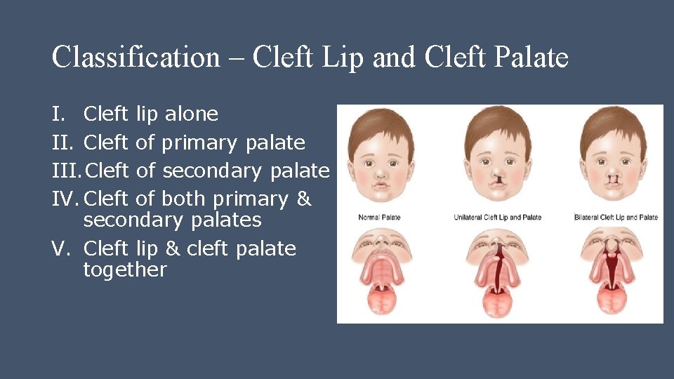 Classification – Cleft Lip and Cleft Palate I. Cleft lip alone II. Cleft of