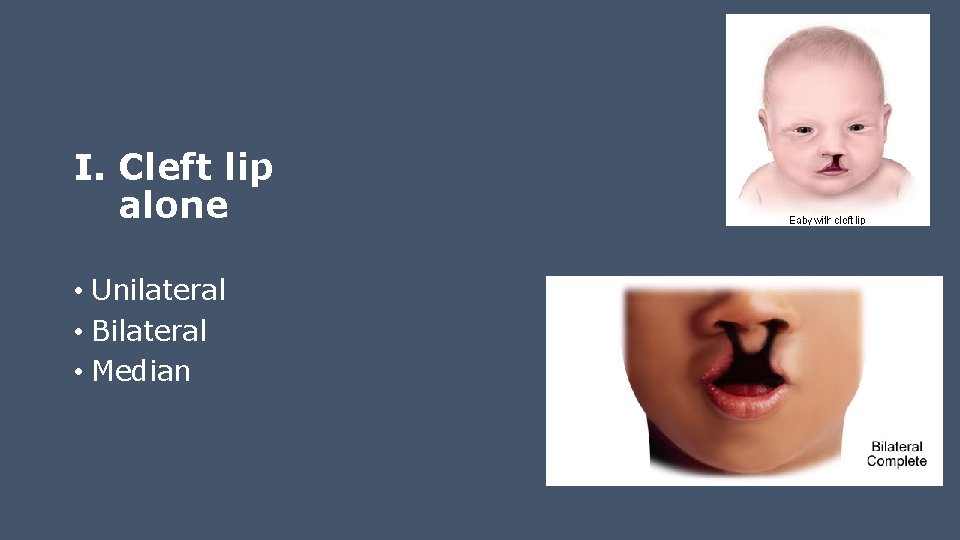 I. Cleft lip alone • Unilateral • Bilateral • Median 