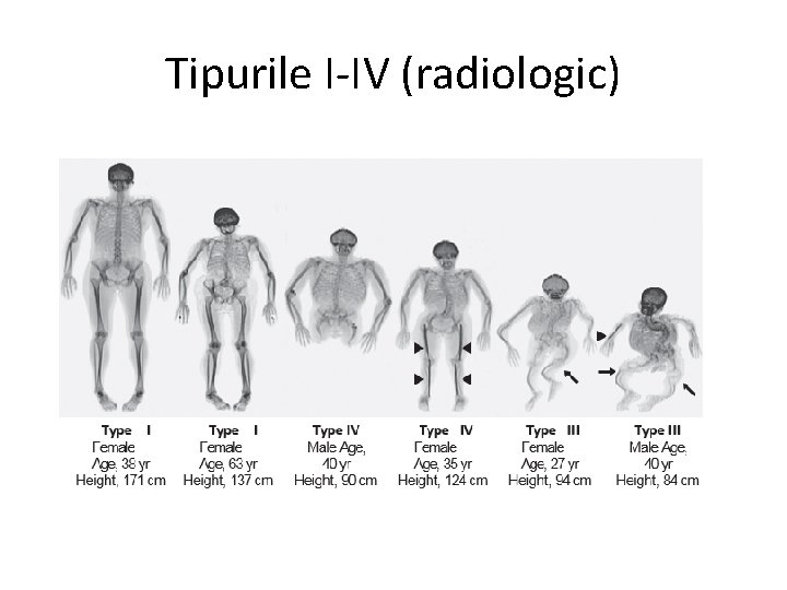 Tipurile I-IV (radiologic) 