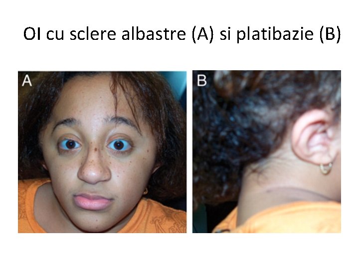 OI cu sclere albastre (A) si platibazie (B) 