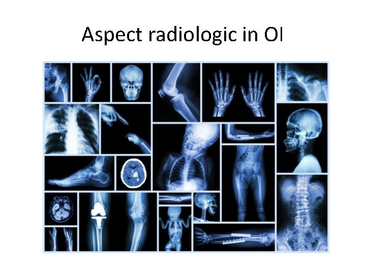 Aspect radiologic in OI 