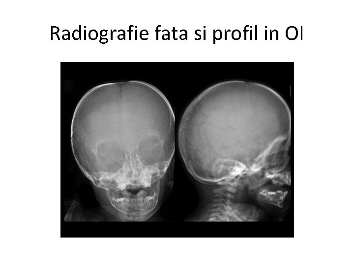 Radiografie fata si profil in OI 