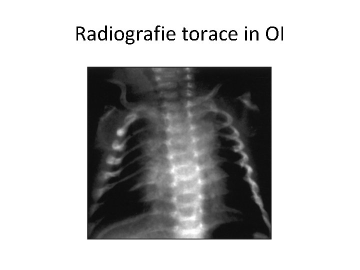 Radiografie torace in OI 