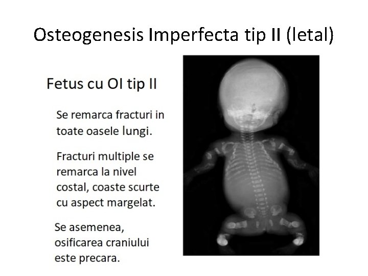 Osteogenesis Imperfecta tip II (letal) 