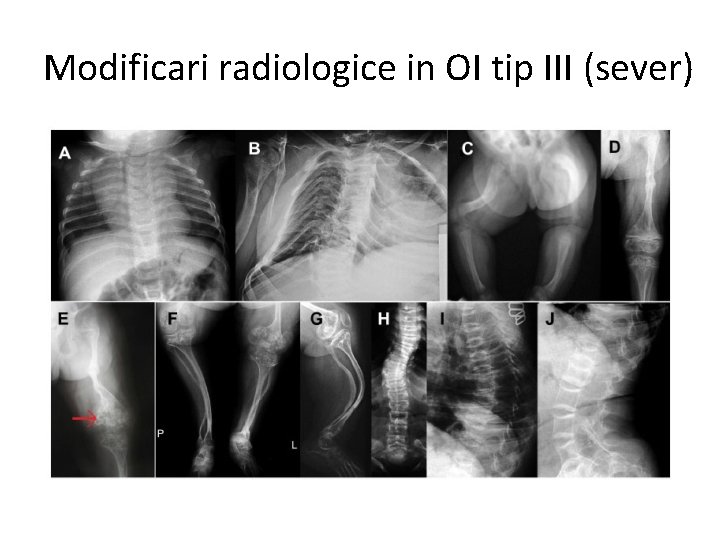 Modificari radiologice in OI tip III (sever) 