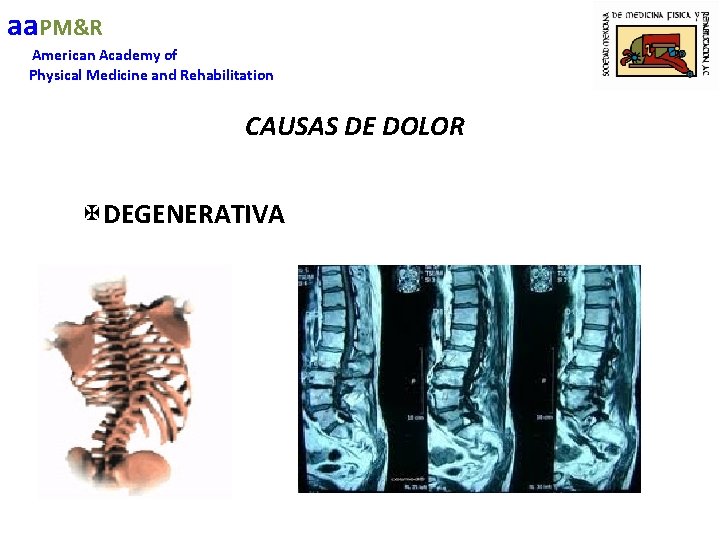 aa. PM&R American Academy of Physical Medicine and Rehabilitation CAUSAS DE DOLOR XDEGENERATIVA 