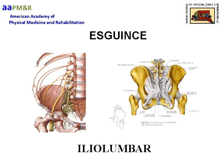 aa. PM&R American Academy of Physical Medicine and Rehabilitation ESGUINCE ILIOLUMBAR 