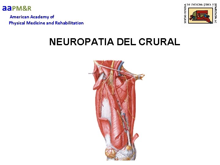 aa. PM&R American Academy of Physical Medicine and Rehabilitation NEUROPATIA DEL CRURAL 