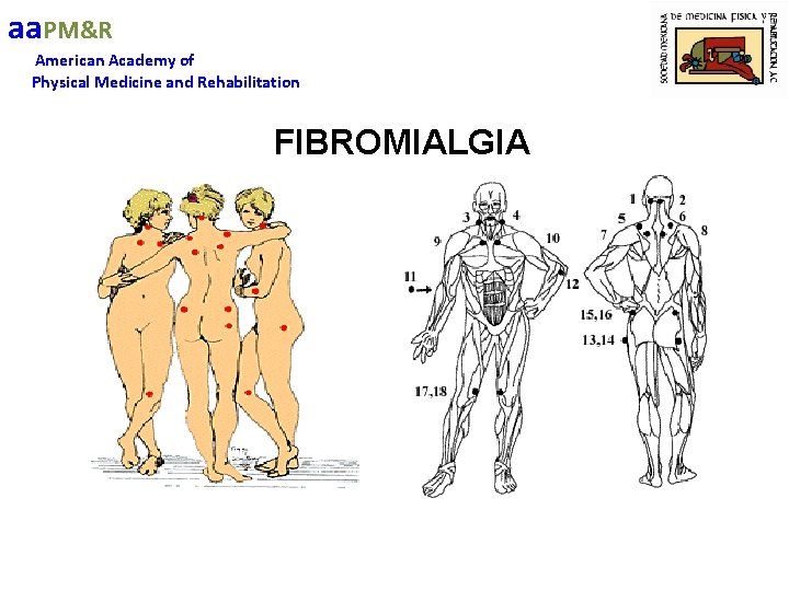 aa. PM&R American Academy of Physical Medicine and Rehabilitation FIBROMIALGIA 