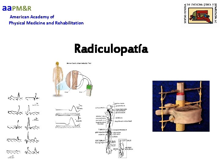 aa. PM&R American Academy of Physical Medicine and Rehabilitation Radiculopatía 