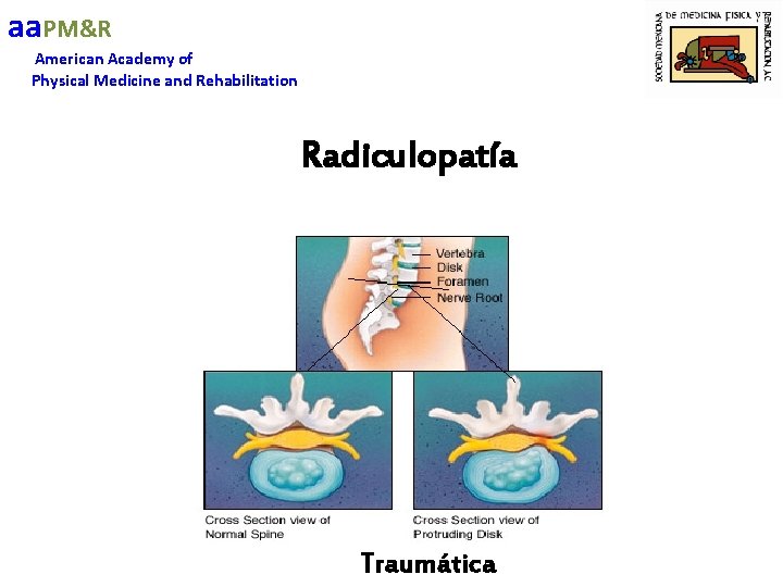 aa. PM&R American Academy of Physical Medicine and Rehabilitation Radiculopatía Traumática 