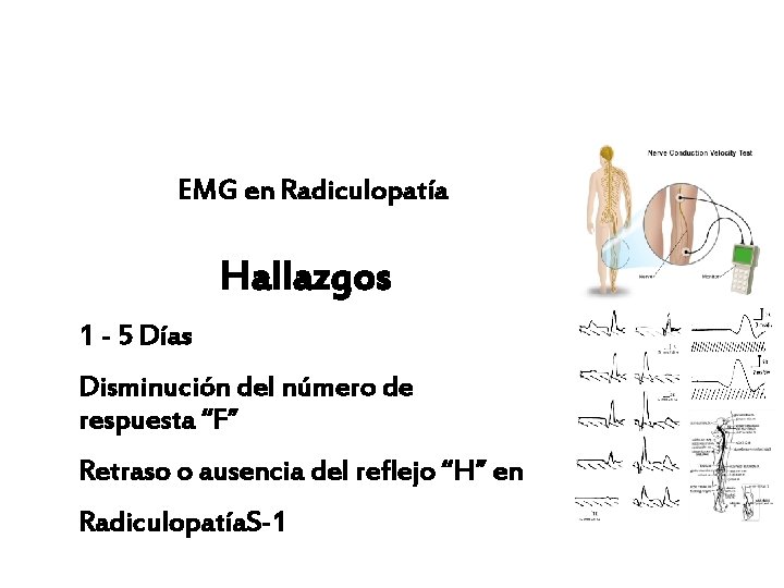 EMG en Radiculopatía Hallazgos 1 - 5 Días Disminución del número de respuesta “F”