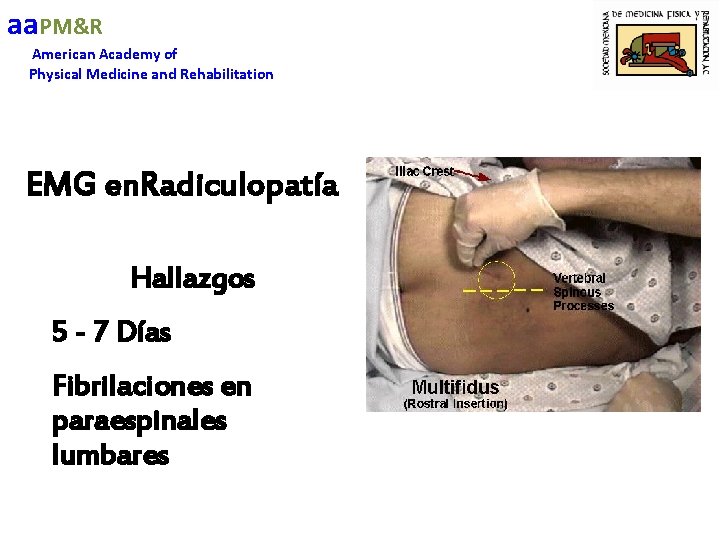 aa. PM&R American Academy of Physical Medicine and Rehabilitation EMG en. Radiculopatía Hallazgos 5