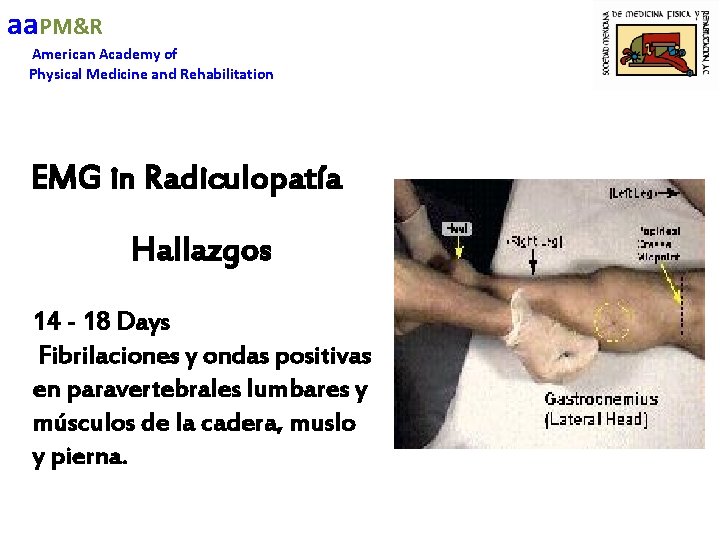 aa. PM&R American Academy of Physical Medicine and Rehabilitation EMG in Radiculopatía Hallazgos 14