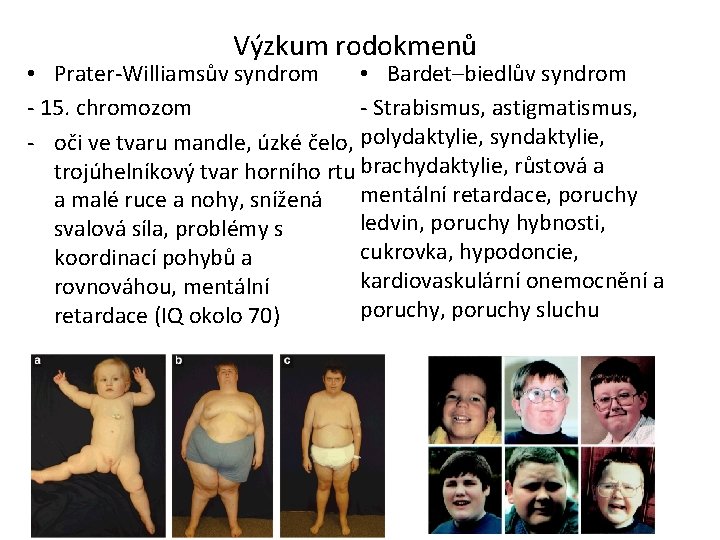 Výzkum rodokmenů • Prater-Williamsův syndrom • Bardet–biedlův syndrom - Strabismus, astigmatismus, - 15. chromozom