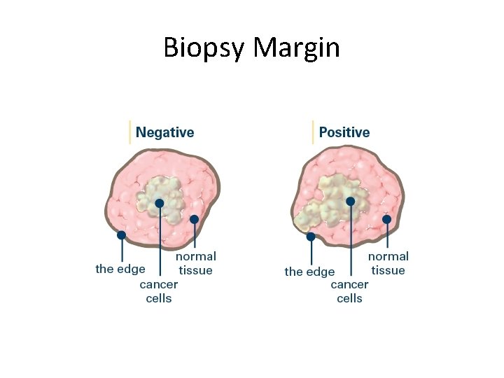 Biopsy Margin 