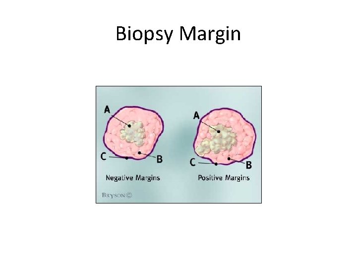 Biopsy Margin 