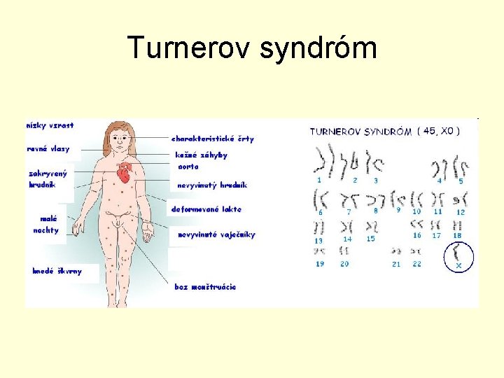 Turnerov syndróm 