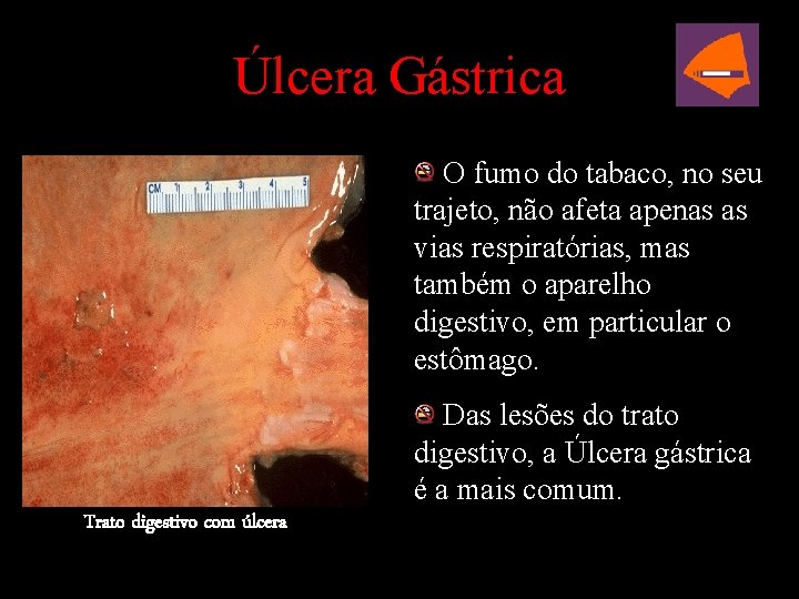 Úlcera Gástrica O fumo do tabaco, no seu trajeto, não afeta apenas as vias