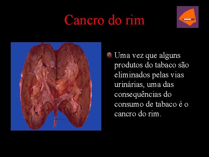 Cancro do rim Uma vez que alguns produtos do tabaco são eliminados pelas vias