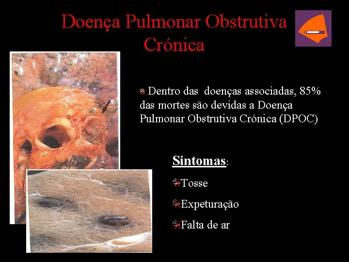 Doença Pulmonar Obstrutiva Crónica Dentro das doenças associadas, 85% das mortes são devidas a