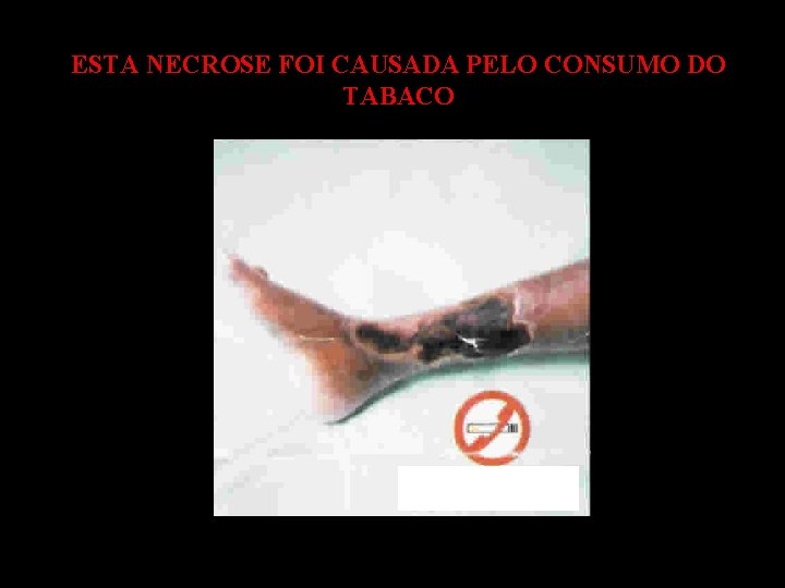 ESTA NECROSE FOI CAUSADA PELO CONSUMO DO TABACO 