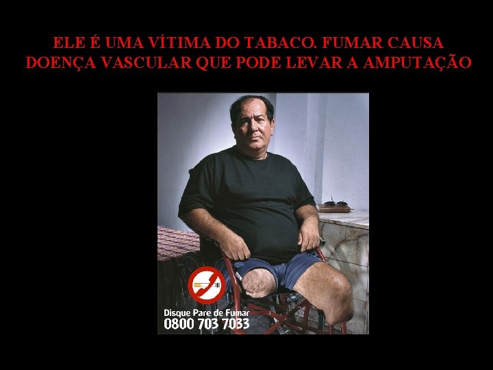 ELE É UMA VÍTIMA DO TABACO. FUMAR CAUSA DOENÇA VASCULAR QUE PODE LEVAR A