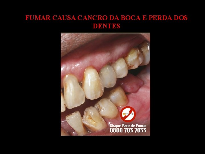 FUMAR CAUSA CANCRO DA BOCA E PERDA DOS DENTES 