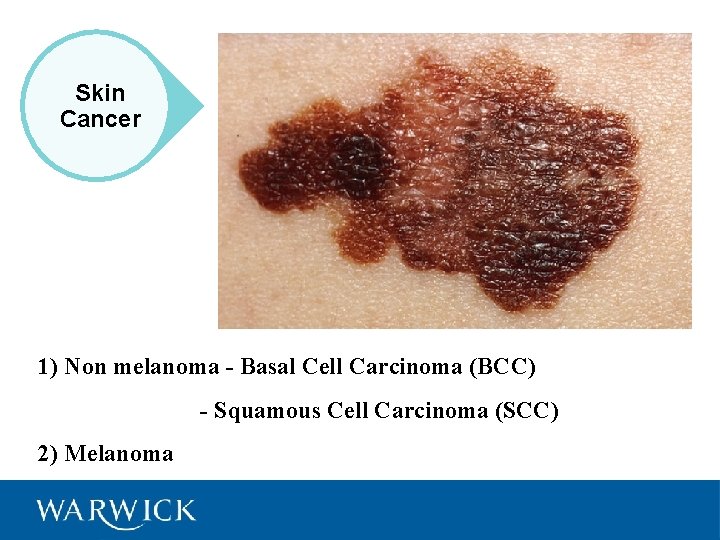 Skin Cancer 1) Non melanoma - Basal Cell Carcinoma (BCC) - Squamous Cell Carcinoma