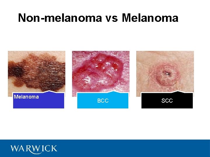 Non-melanoma vs Melanoma BCC SCC 