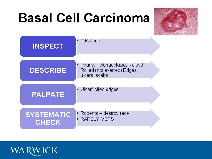 Basal Cell Carcinoma INSPECT DESCRIBE PALPATE SYSTEMATIC CHECK • 90% face • Pearly, Telangectasia,