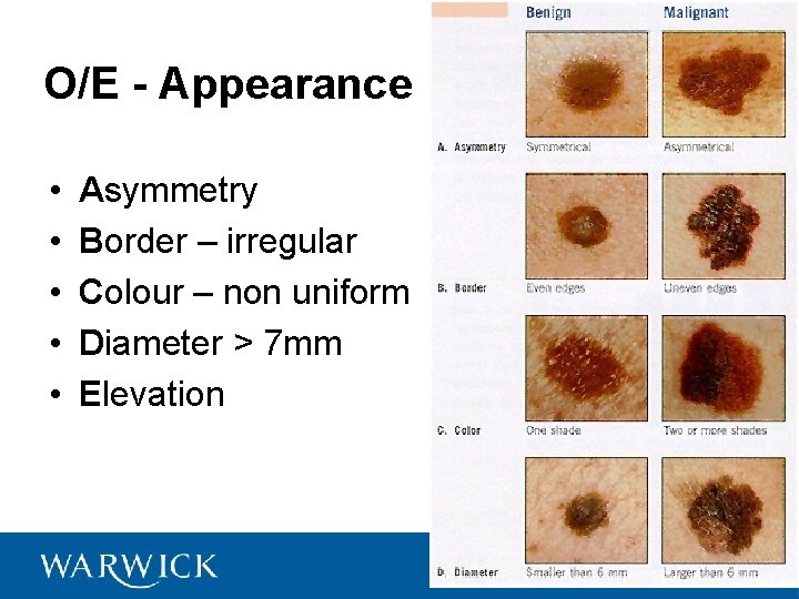 O/E - Appearance • • • Asymmetry Border – irregular Colour – non uniform