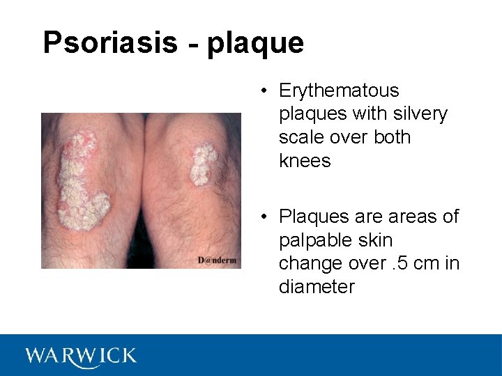 Psoriasis - plaque • Erythematous plaques with silvery scale over both knees • Plaques