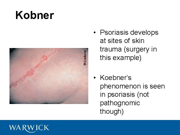 Kobner • Psoriasis develops at sites of skin trauma (surgery in this example) •