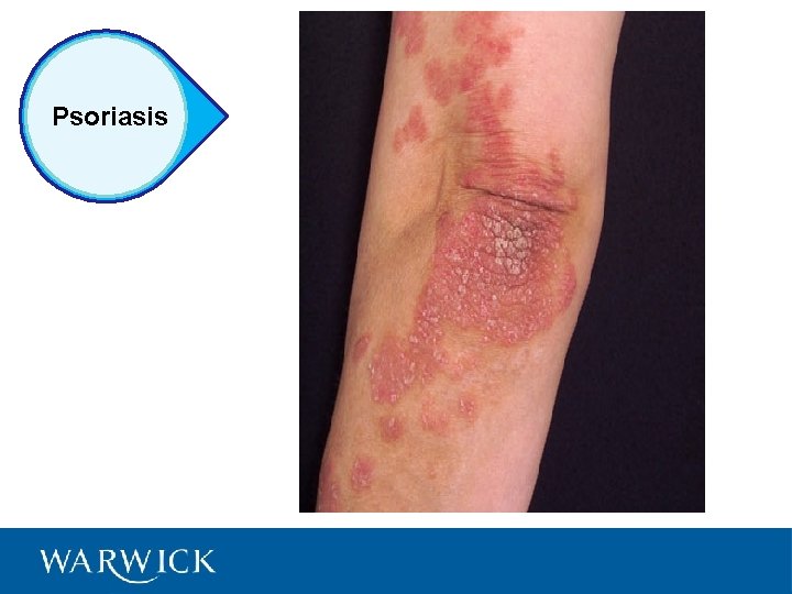 Psoriasis 